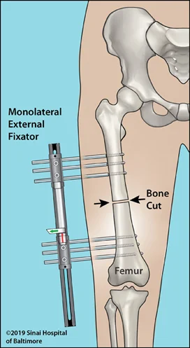 Illustration of monolateral external fixator applied to the femur