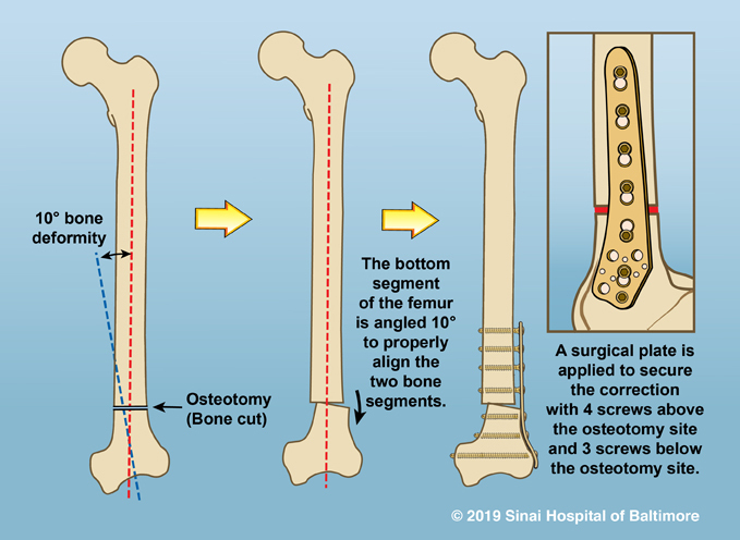 Plate used to maintain correct alignment after osteotomy in femur