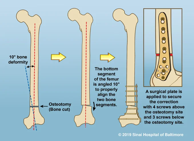 Plate used to maintain correct alignment after osteotomy in femur