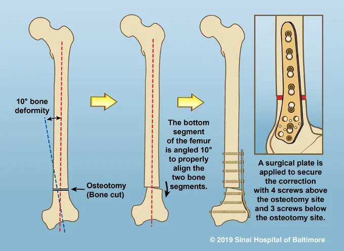 Deformity Correction: The Process  International Center for Limb