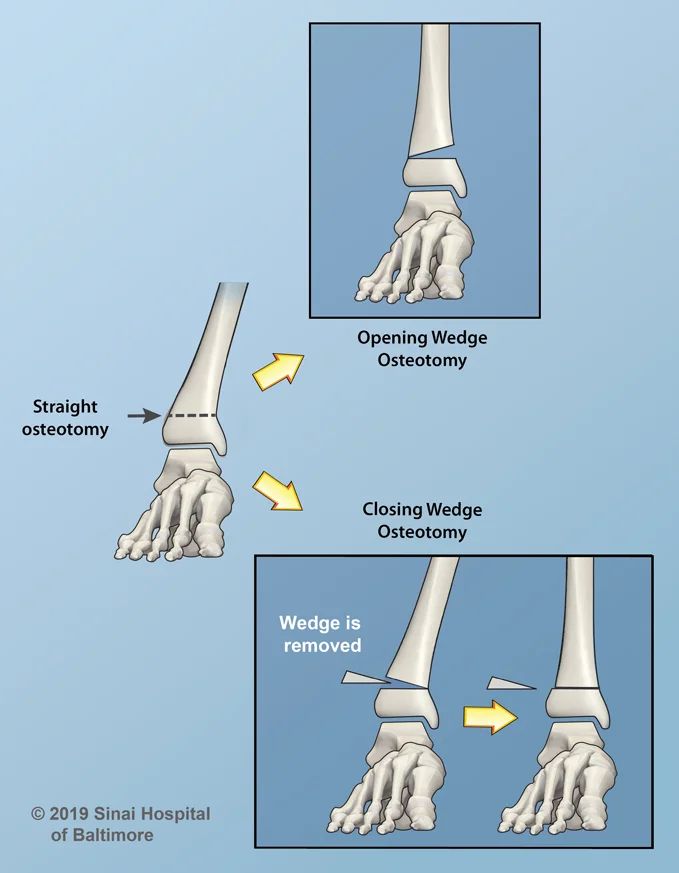 Opening and Closing Wedge Osteotomies