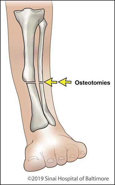 Osteotomy in a deformed tibia