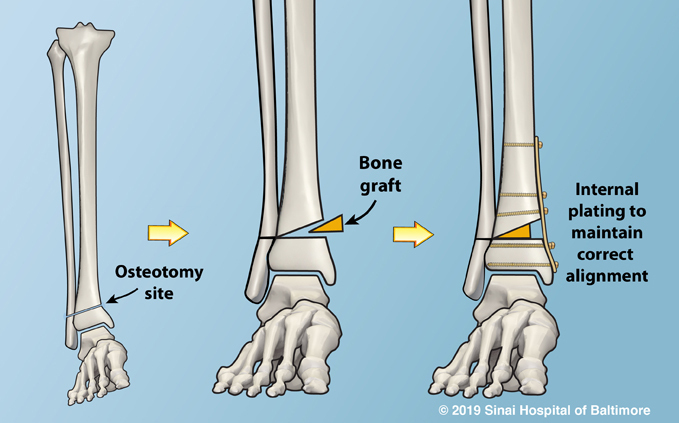 Plate used to maintain correct alignment after osteotomy