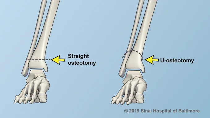 Straight Osteotomy and U-Osteotomy