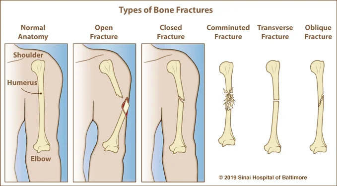 Six color illustrations, each showing a tibia and fibula. The first image shows a normal immature bone and identifies the epiphysis, metaphysis, tibia and growth plate. It is followed by examples of each of the five types of growth plate fractures.