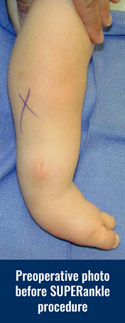 Preoperative photo of a patient's leg before SUPERankle procedure for fibular hemimelia