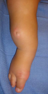 A patient's leg with fibular hemimelia before SUPERankle realignment surgery