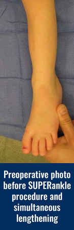 Preoperative photo of a patient's leg before SUPERankle procedure and simultaneous lengthening
