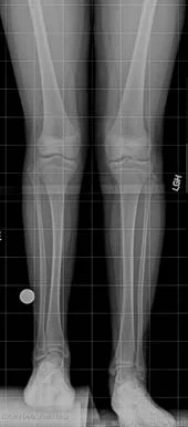 X-ray showing a patient's legs before tibial lengthening treatment for fibular hemimelia