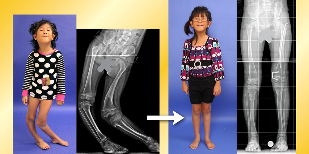 Pictures and X-rays showing a young girl with very crooked legs and a picture and X-ray of her straignt legs after treatment at the International Center for Limb Lengthening