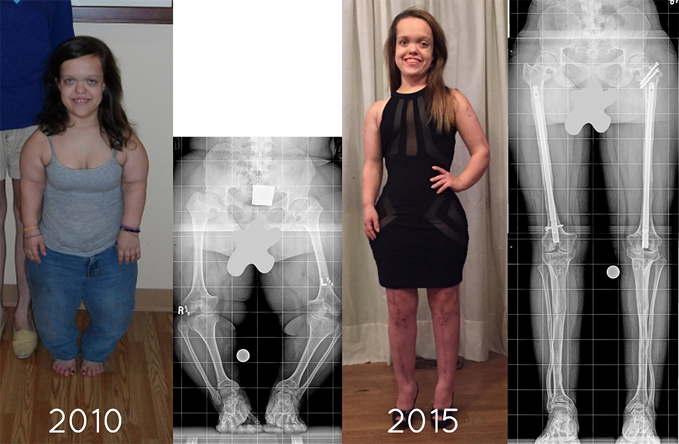 A set of four images: two photos and two X-rays of a female patient with achondroplasia. One picture is labeled 2010 and that picture and the first X-ray from her waist down show her before treatment. A second picture labeled 2015 depicts Chandler after completing treatment where she is significantly taller; the accompanying X-ray from the waist down post-treatment shows her dramatically longer and straighter legs.