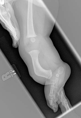 Lateral view x-ray of the leg of a child with fibular hemimelia