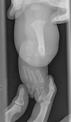 Bird's eye view x-ray of the leg of a child with fibular hemimelia