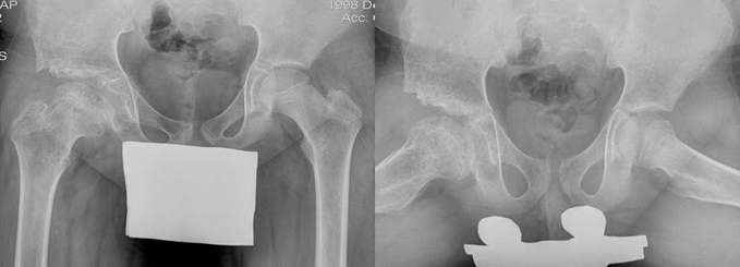 X-rays of the hip of a patient with Perthes disease after hip distraction treatment.