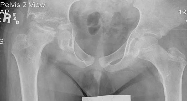 X-ray of the hip of a patient with Perthes disease before hip distraction treatment.