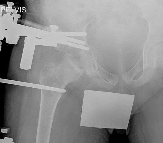 X-ray of the hip of a patient with Perthes disease during hip distraction treatment.
