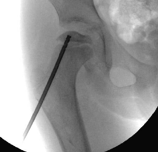 X-ray showing injection of bone stem cells into the femoral head to treat Perthes disease