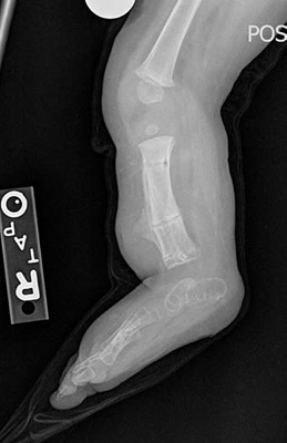 Lateral x-ray of the leg of a patient with fibular hemimelia, after a SUPERankle procedure was performed and the external fixator was removed, showing the deformities have been corrected