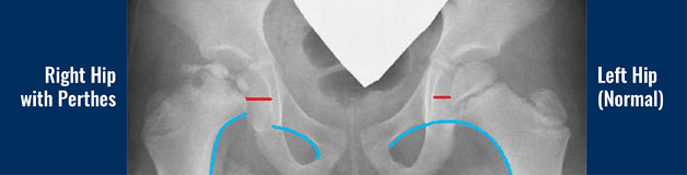 X-ray showing a normal hip and a hip that has Perthes