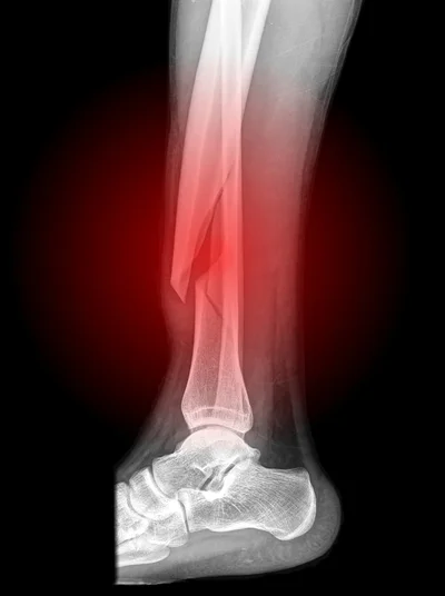 Side view x-ray of a lower leg fracture