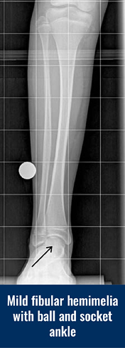 X-ray of the leg of a patient with mild fibular hemimelia with ball and socket ankle