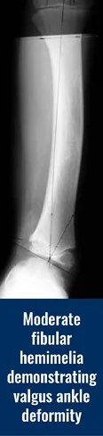 X-ray of the leg of a patient with moderate fibular hemimelia, demonstrating valgus ankle deformity