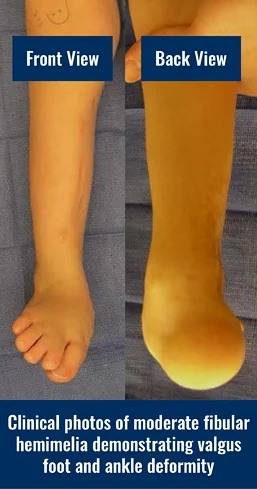Front and back photos of the leg of a patient with moderate fibular hemimelia, demonstrating valgus foot and ankle deformity