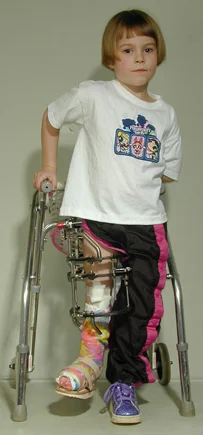 Emily as a very young girl with an external fixator and walker showing her significant limb length discrepancy