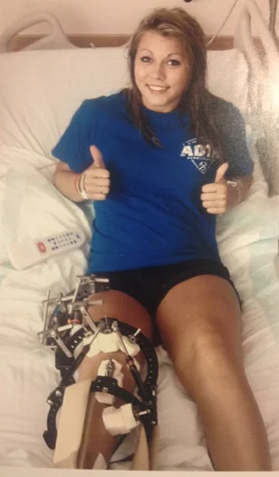 Emily as a young adult giving two thumbs up while in a hospotal bed with an external fixator on her leg