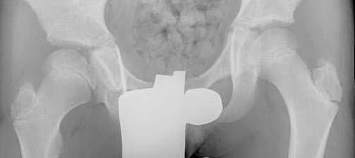 X-ray of human pelvis and femoral heads, showing Stage 1 (precollapse) of Perthes disease