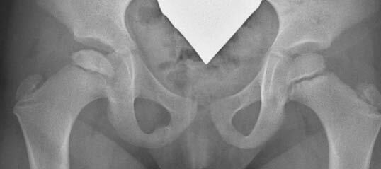 X-ray of human pelvis and femoral heads, showing Stage 2 (early collapse) of Perthes disease