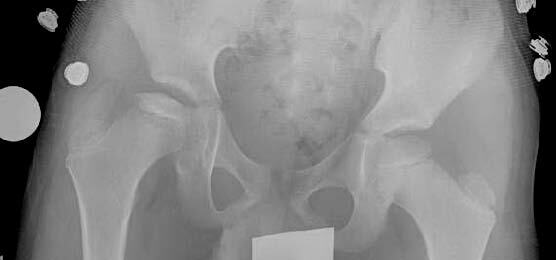 X-ray of human pelvis and femoral heads, showing Stage 3 (mid-collapse) of Perthes disease