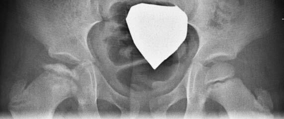 X-ray of human pelvis and femoral heads, showing Stage 4 (late collapse) of Perthes disease