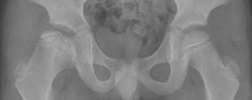 X-ray of human pelvis and femoral heads, showing Stage 8 (late reconstitution) of Perthes disease