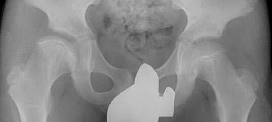 X-ray of human pelvis and femoral heads, showing Stage 9 (reconstituted) of Perthes disease