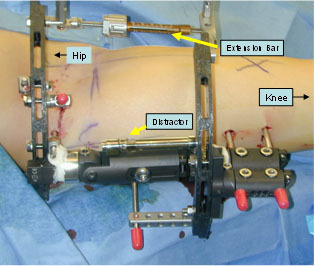 Closeup of a leg with an external fixator applied, with labels showing the extension bar and distractor
