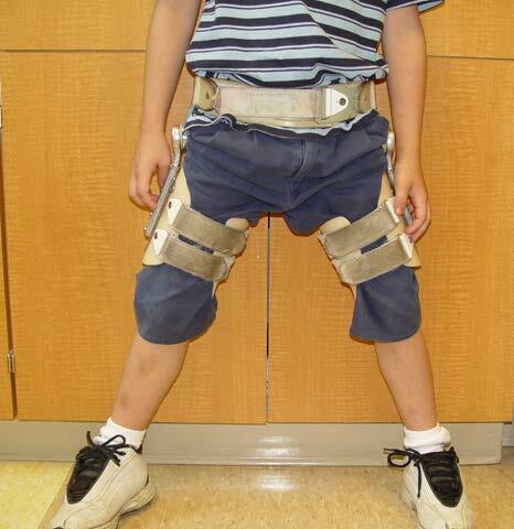 A child wearing a Scottish Rite Brace