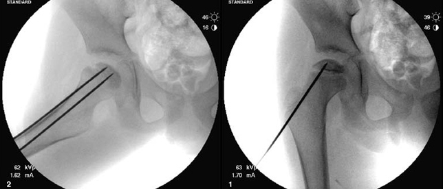 X-rays showing small-diameter core decompression