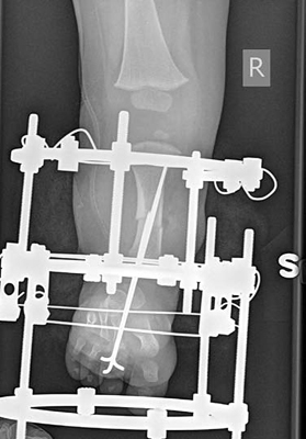 AP view x-ray of the leg of a child with fibular hemimelia, after a SUPERankle procedure was performed and an Ilizarov external fixator was applied