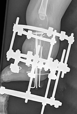Lateral view x-ray of the leg of a child with fibular hemimelia, after a SUPERankle procedure was performed and an Ilizarov external fixator was applied