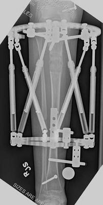 X-ray of a patient's tibia during the consolidation phase of tibial lengthening