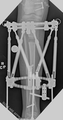 X-ray of a patient's tibia during the distraction phase of tibial lengthening