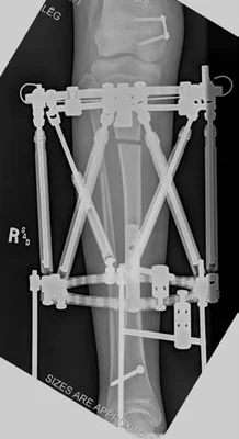 X-ray of a patient's tibia after an osteotomy was performed and an external fixator was applied to lengthen the tibia