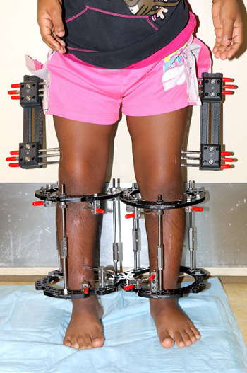 Patient standing with bilateral simultaneous femoral and tibial external fixation