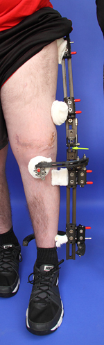Monolateral external fixator applied to the leg