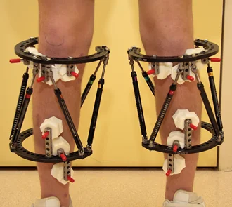 Taylor Spatial Frames (TSF) applied to both tibia