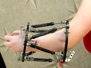Patient with Taylor Spatial Frame (TSF) applied to the forearm