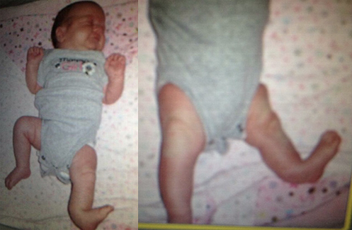 Ally as a baby showing her posteromedial tibial bowing