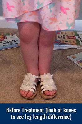 Ally's legs before treatment with height of knees showing a leg length discrepancy