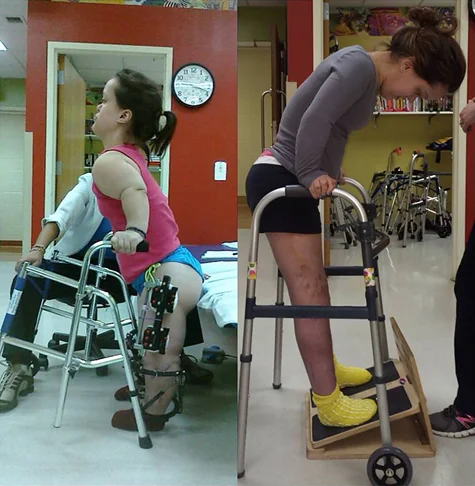 Two side-by-side pictures of Chandler; one at the start of her treatment with a walker and wearing external fixators on her legs in physical therapy, and one showing her significantly taller after lengthening doing a physical therapy exercise while using a walker for balance on an inclined foot board.